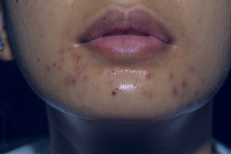 foto penyebab jerawat di dagu